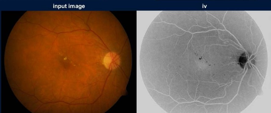 AI Retina Analysis - 1